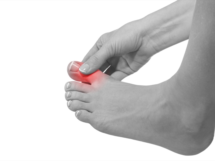 Acupuncture for Gout