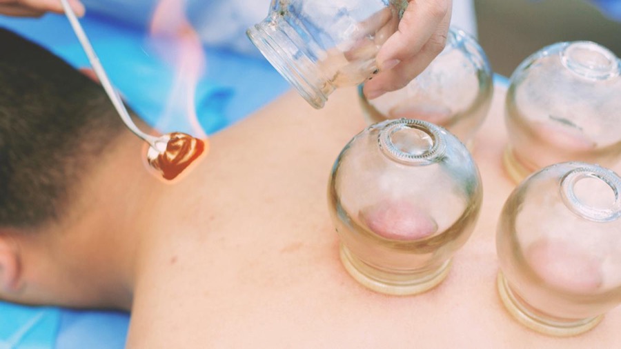 Cupping therapy