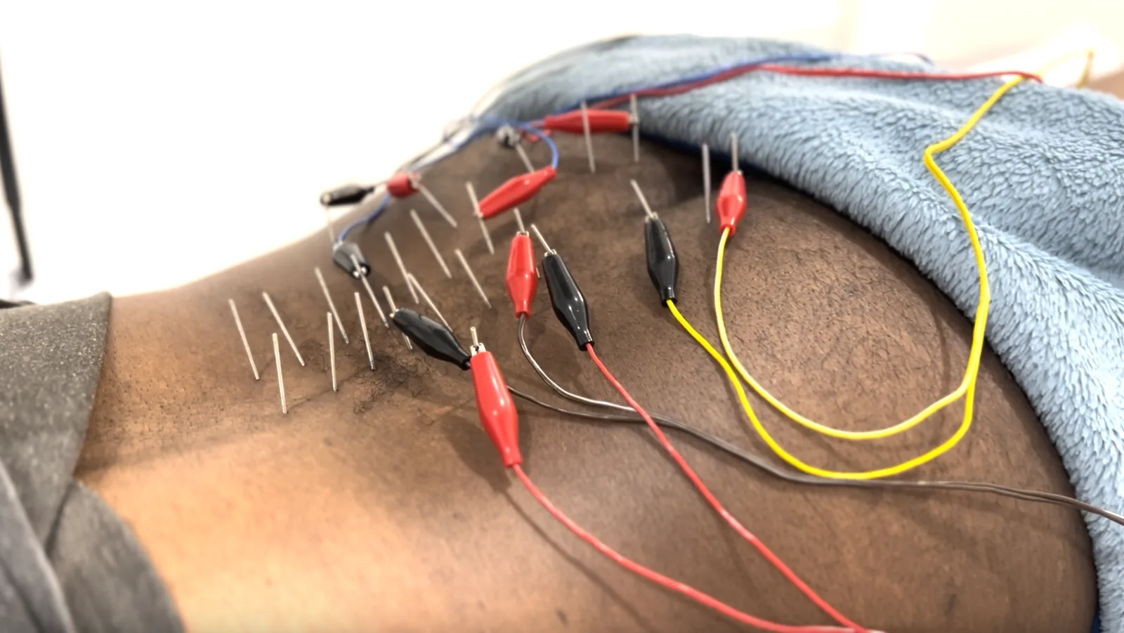 Electro-acupuncture in our clinic