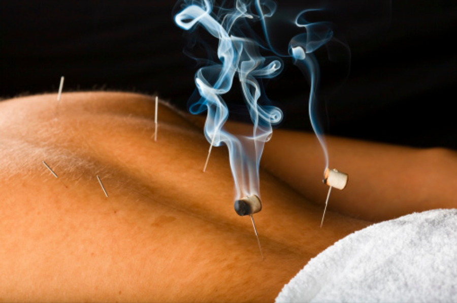 Moxa+Acupuncture