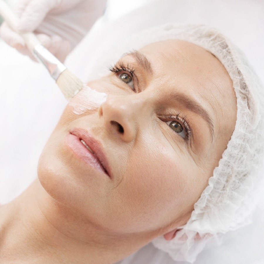 Skin Peels