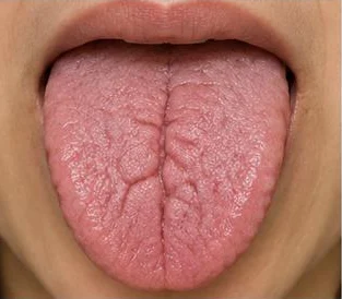 Example: deeply cracked tongue