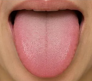 Example: a healthy tongue