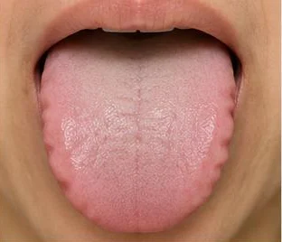 Example: swollen tongue with teeth marks
