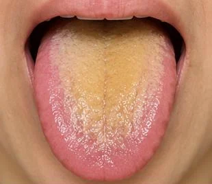 Example: yellow, greasy coating